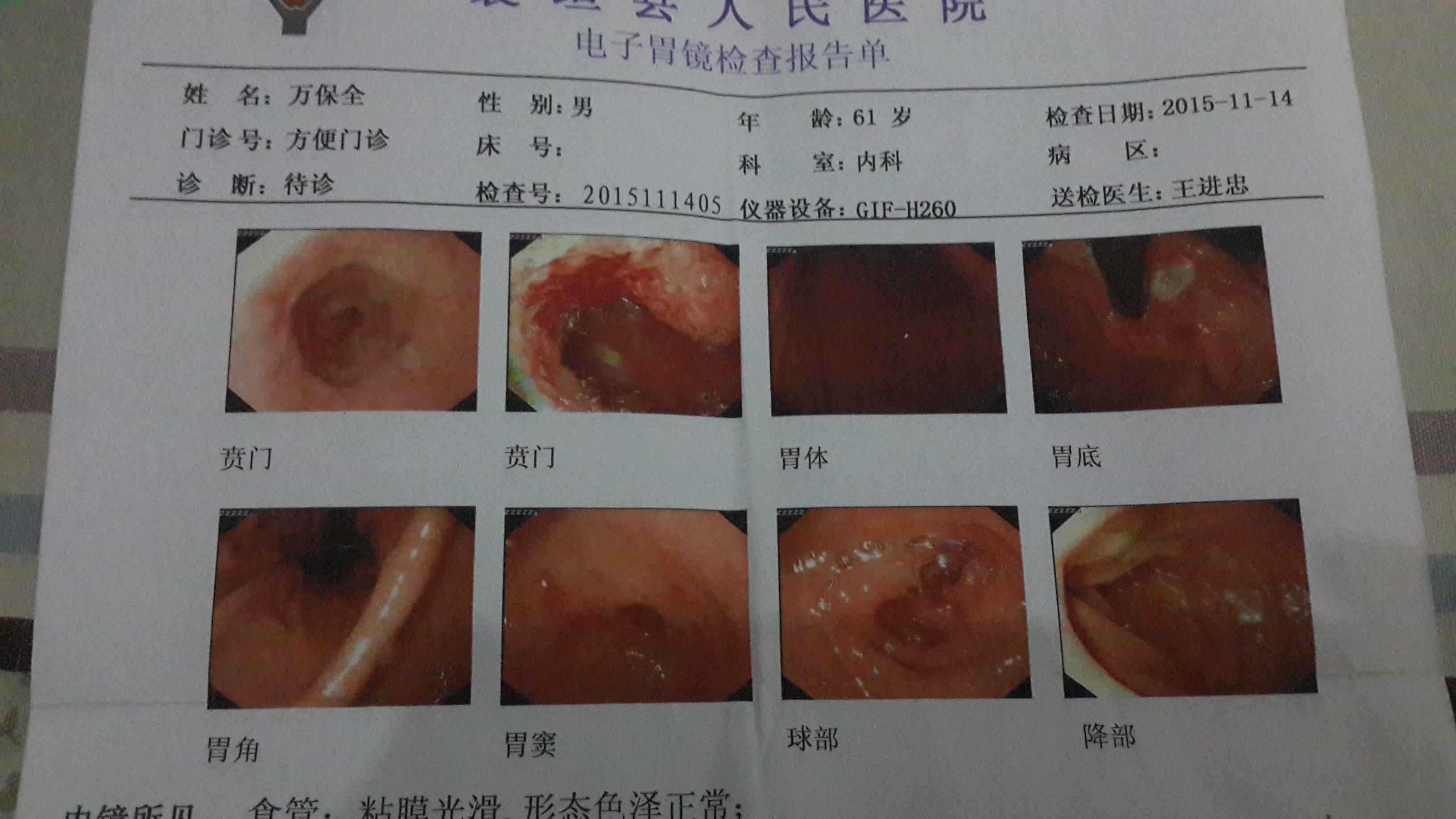 喷门炎早期是什么症状,喷门