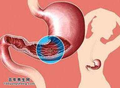 胃溃疡的症状及治疗猪胃溃疡的症状及治疗