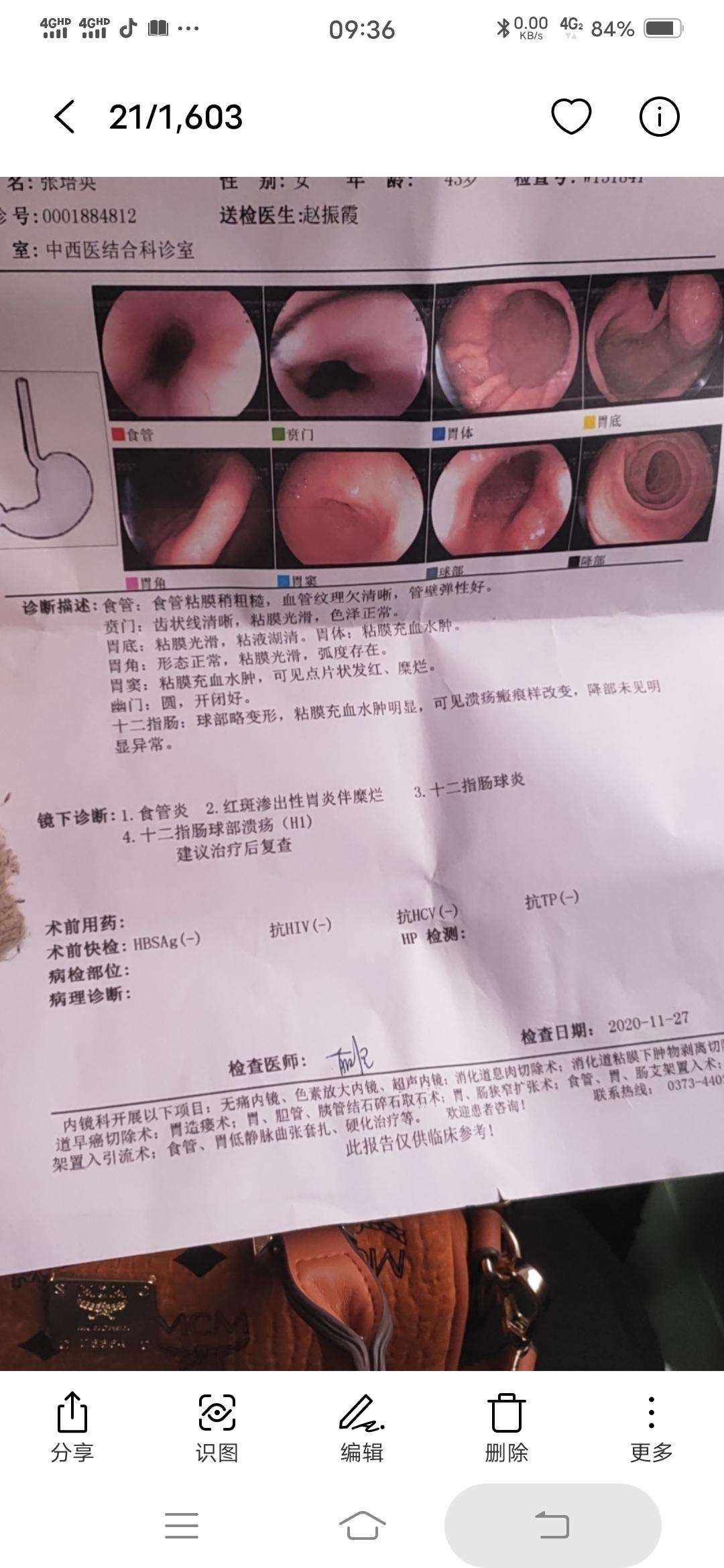 胃溃疡的症状及治疗猪胃溃疡的症状及治疗