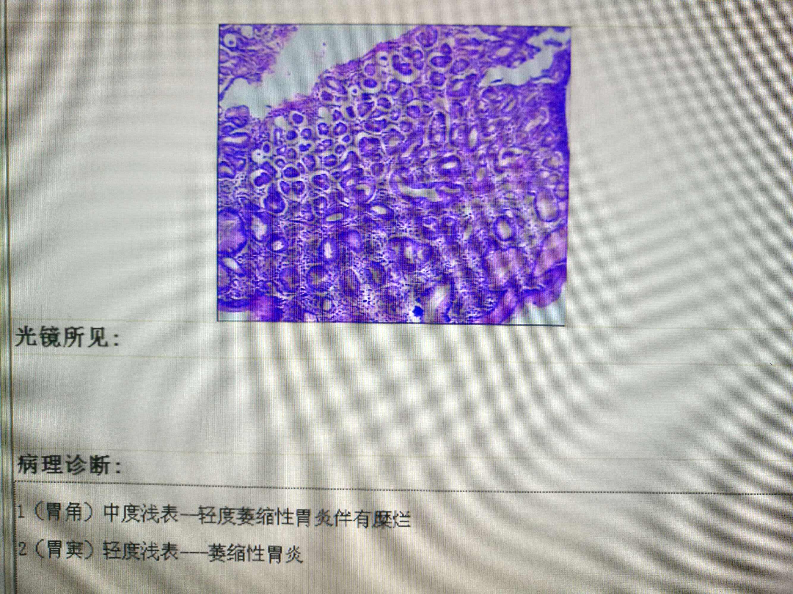 浅表萎缩性胃炎hp阳性浅表萎缩性胃炎