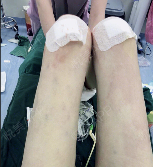 大腿小腿减肥左大腿外侧有麻木感
