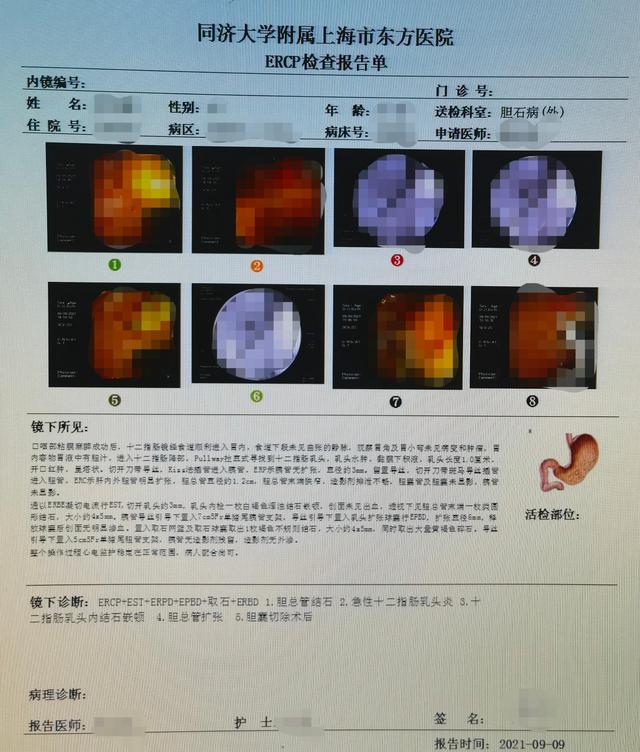 十二指肠癌临终前预兆十二指肠乳头癌