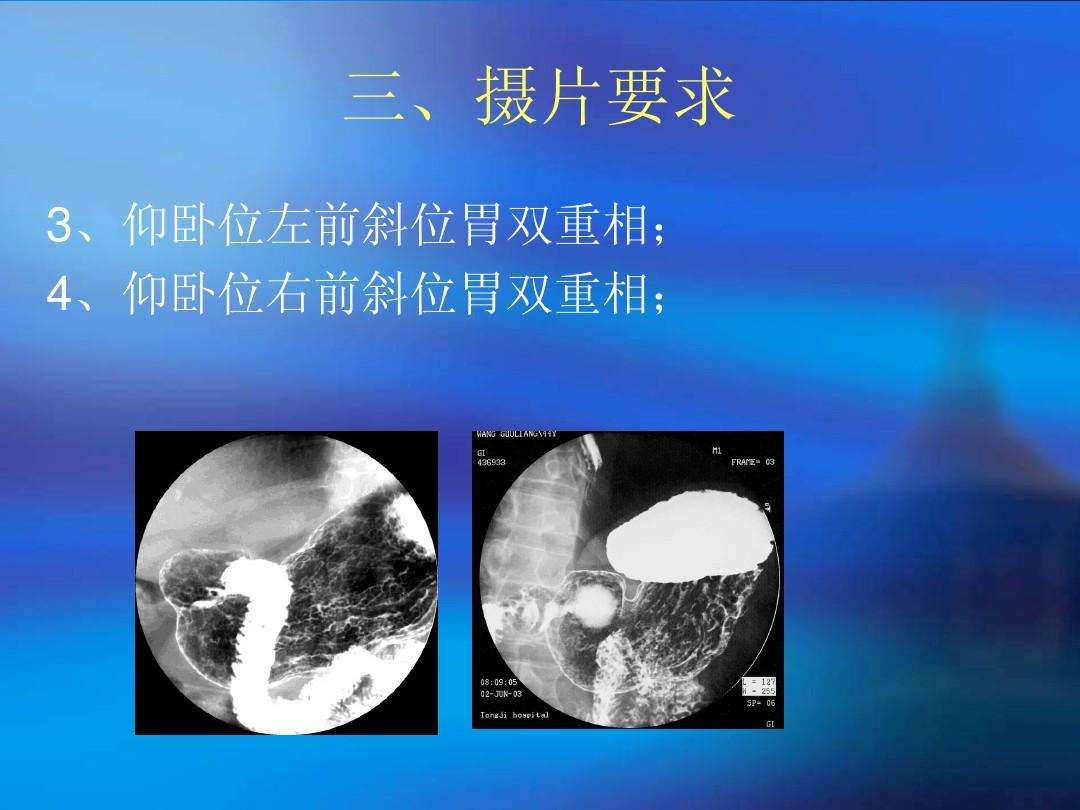 消化道造影消化道造影是什么造影