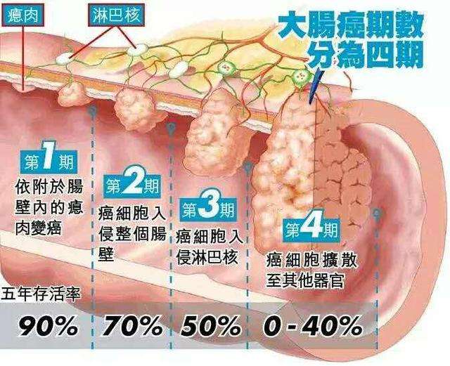 肛管直肠癌,肠癌为什么叫幸运癌