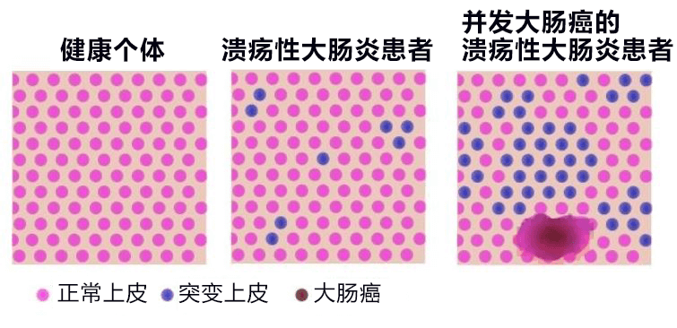 溃疡直肠竟然痊愈了溃疡性大肠炎