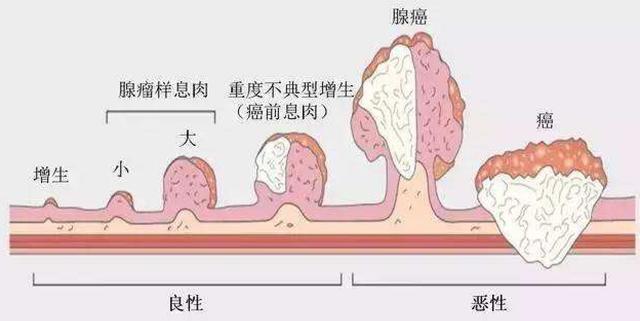 结肠息肉多大需要切除结肠息肉