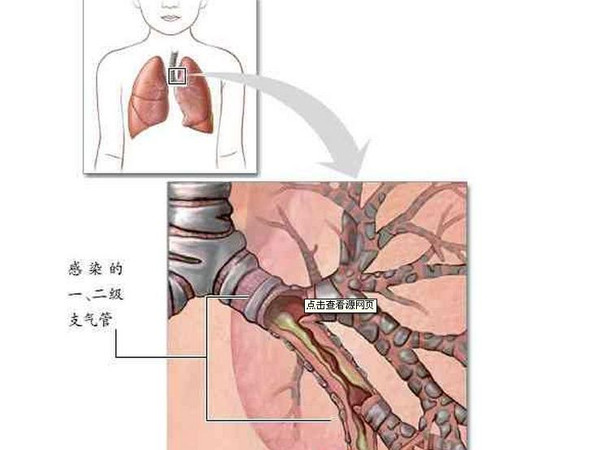 小孩哮喘是怎么引起的哮喘的主要症状是