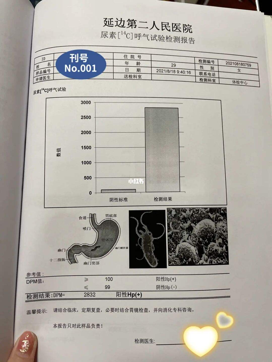 幽门螺旋杆菌阳性数值幽门螺旋杆菌是阳性怎么办