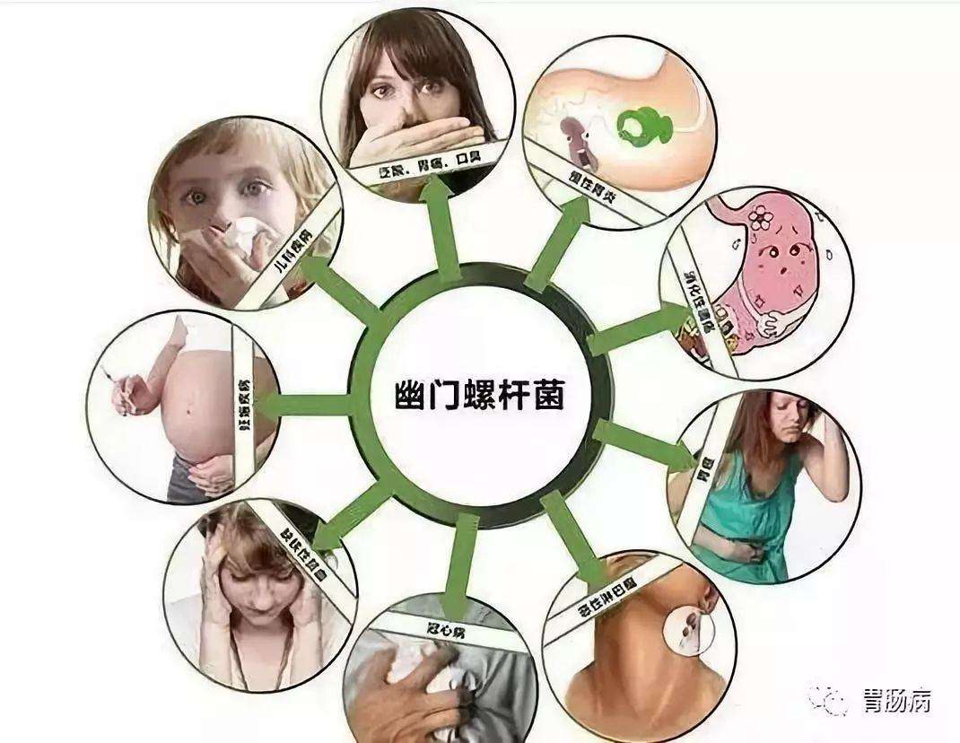 幽门螺杆菌是什么症状及表现幽门螺旋杆菌的症状怎么自我发现