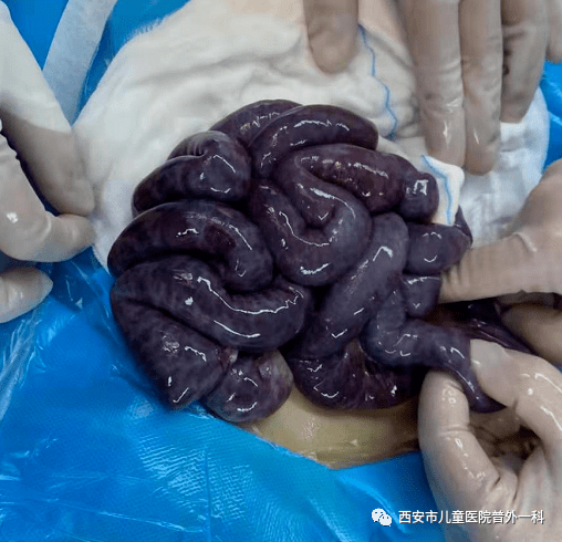 肠扭转,肠扭转了能自愈吗