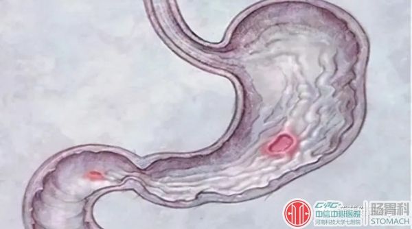 胃窦炎的症状及治疗胃窦炎严重吗