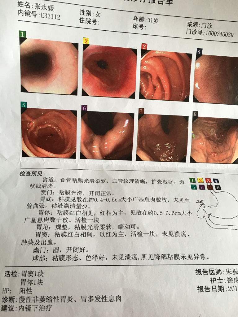 胃窦炎的症状及治疗胃窦炎严重吗