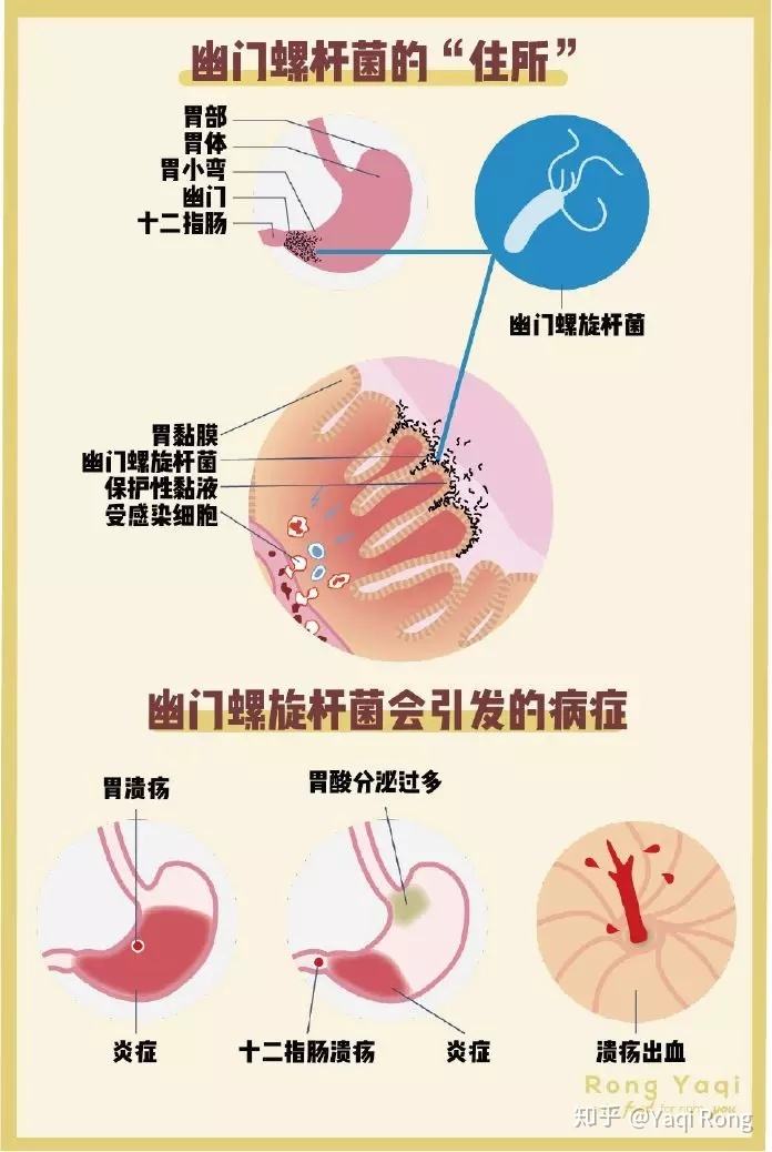 关于幽门螺旋杆菌阳性是什么病会传染吗的信息
