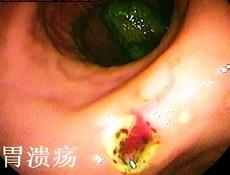 胃溃疡的症状,十二指肠溃疡的症状
