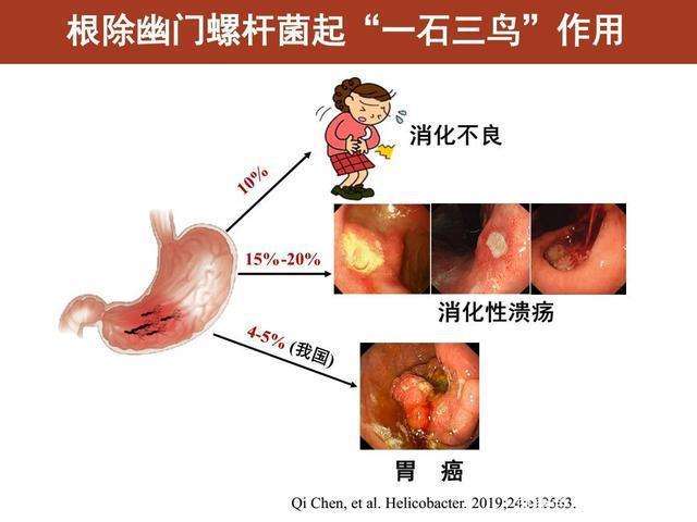 幽门螺旋杆菌的筛查方法幽门螺旋杆菌的筛查方法是