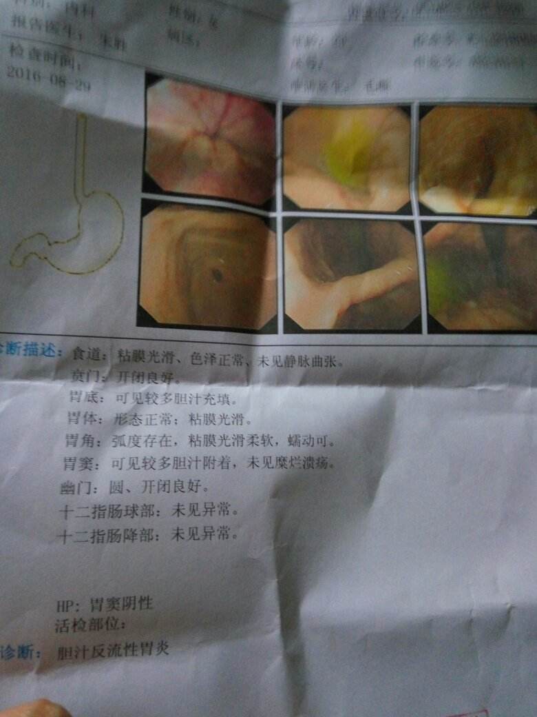 胆汁反流是怎么回事胆汁反流