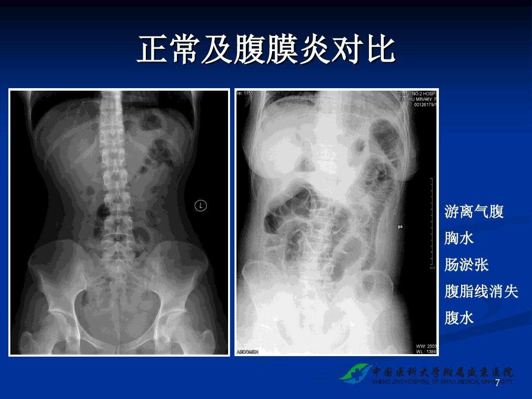 腹膜炎有哪些症状,是怎么引起的腹膜炎