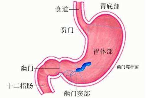 幽门梗阻是什么原因引起的幽门梗阻