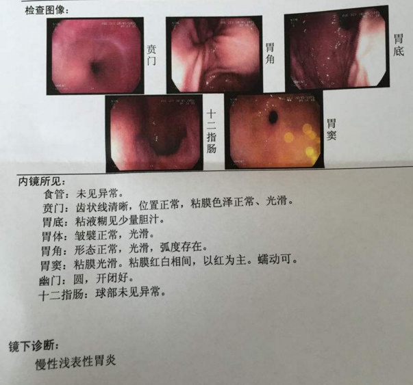 浅表性胃炎会癌变吗,浅表性胃炎