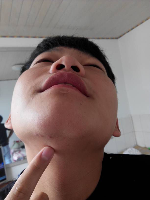下颚淋巴结疼痛,下颚