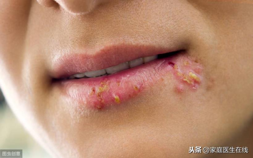 嘴角上火,嘴角上火起泡是什么原因引起的