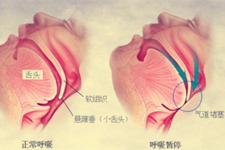 睡觉打噜是什么原因引起的睡觉打噜是什么原因?