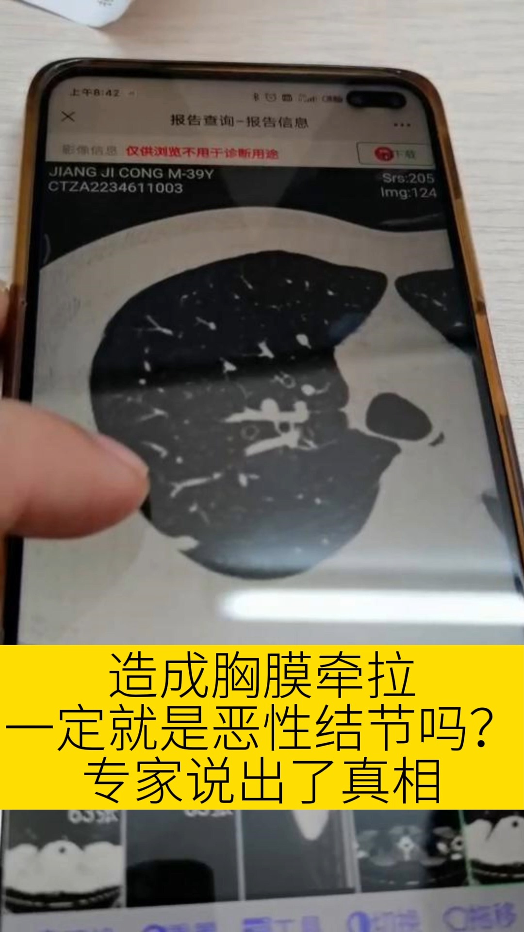 胸膜增厚是肺癌早期吗,胸膜